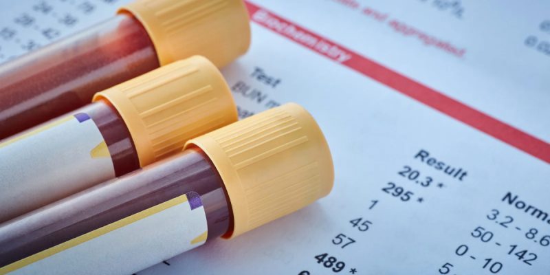 Prolaktin Testi Nedir?