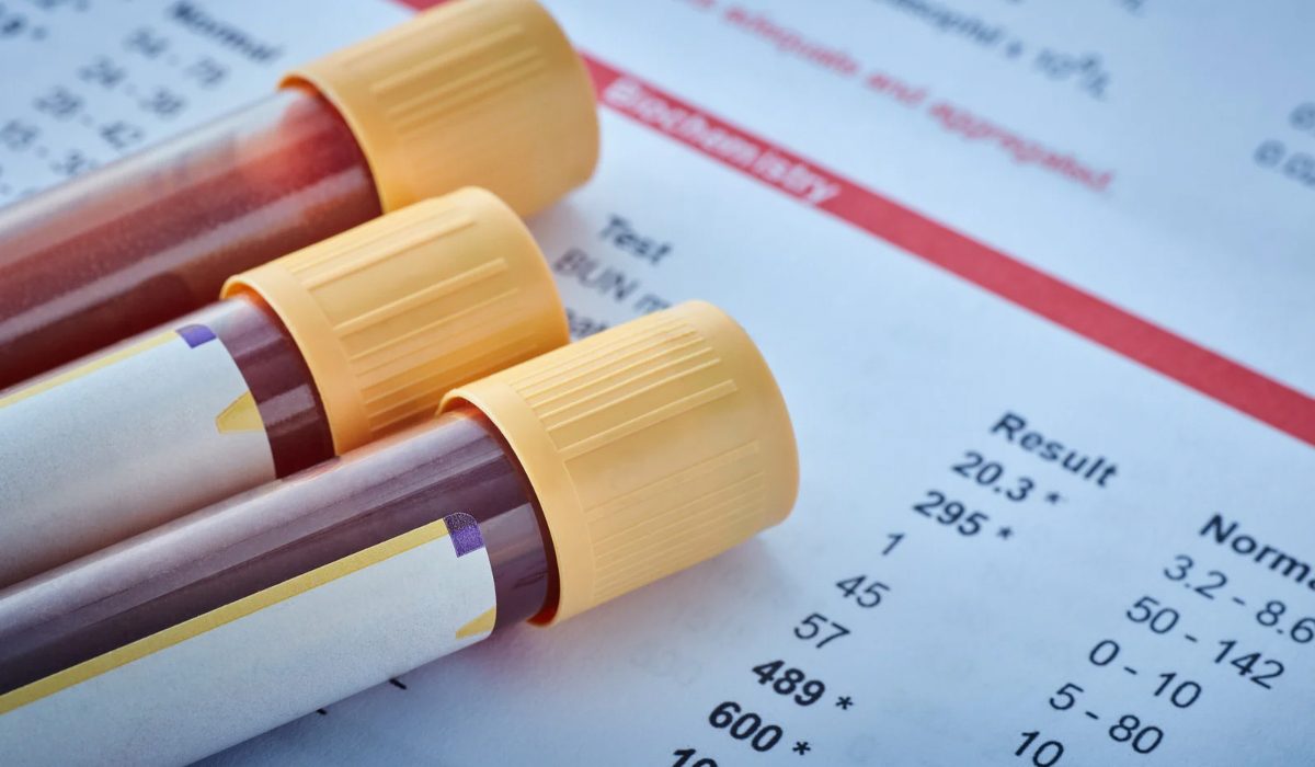 Prolaktin Testi Nedir?