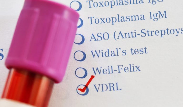 VDRL Testi