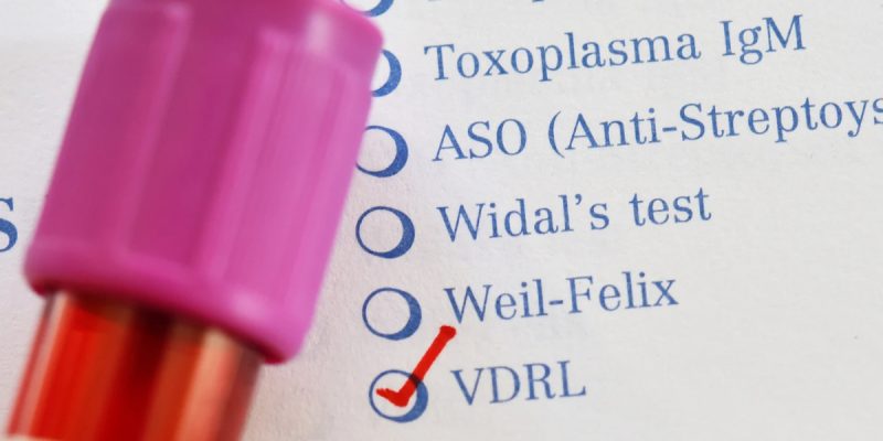 VDRL Testi Nedir?