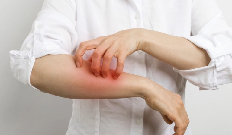 Cilt Alerjisi Nedir?