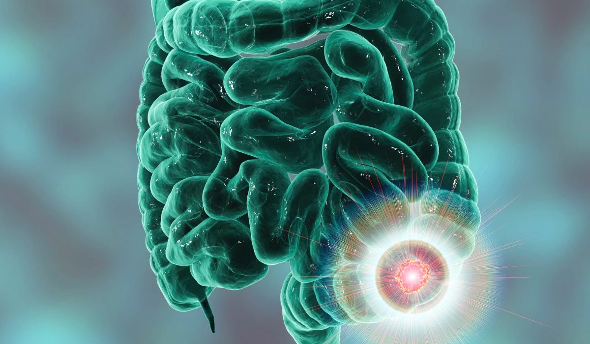 Kalprotektin (Fekal Calprotectin) Testi Nedir?
