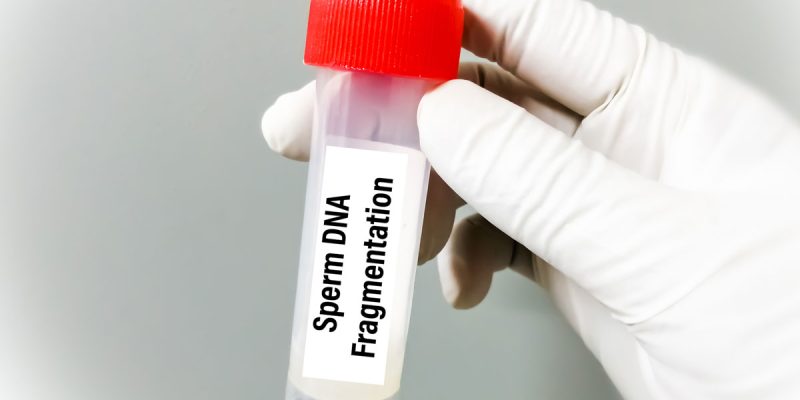 Sperm DNA Hasar (Fragmantasyon) Testi Nedir?