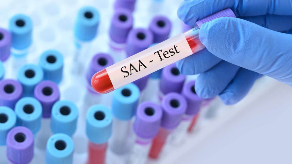 Amiloid A Testi Nedir?