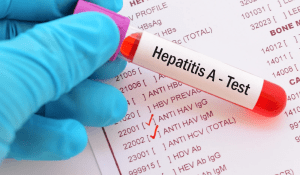 Anti HAV IgM Testi