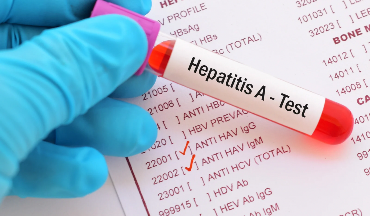 Anti HAV IgM Testi Nedir? Nasıl Bulaşır?