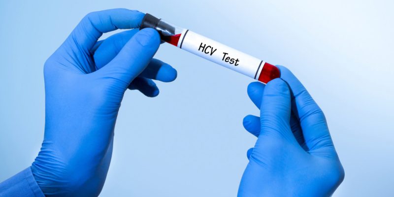 Anti HCV Testi Sonucu Kaç Olmalı?