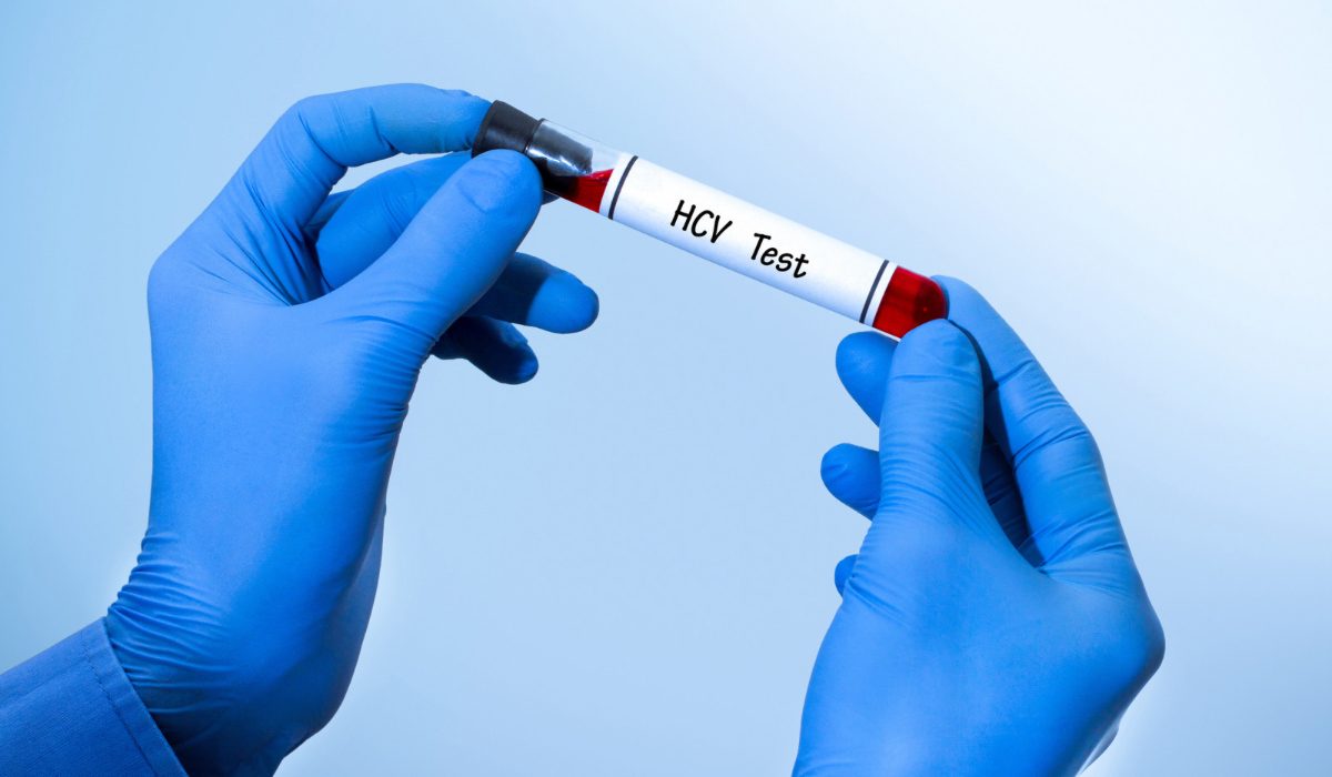 Anti HCV Testi Sonucu Kaç Olmalı?