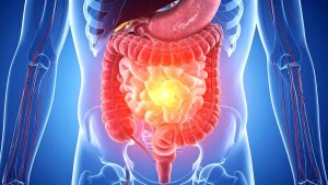 Geçirgen Bağırsak Sendromu