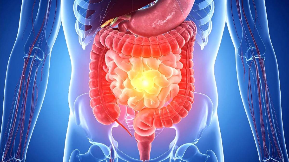 Geçirgen Bağırsak Sendromu Nedir?