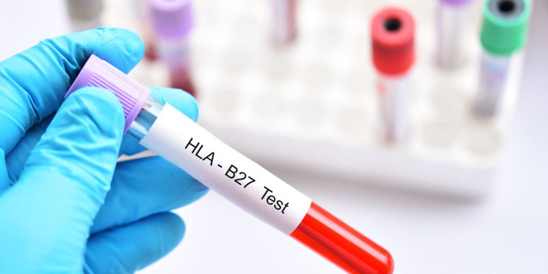 HLA B27 Nedir?