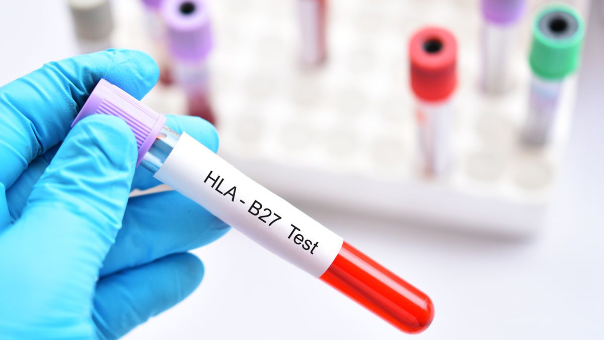 HLA B27 Nedir?