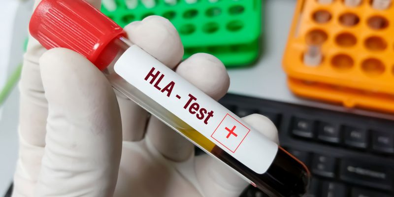 HLA DQ2 DQ8 Testi Nedir?