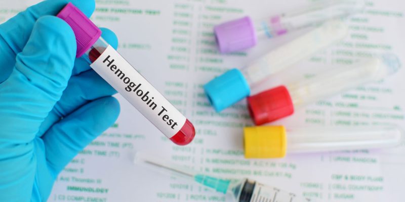 Hemoglobin Elektroforezi Testi Nedir?