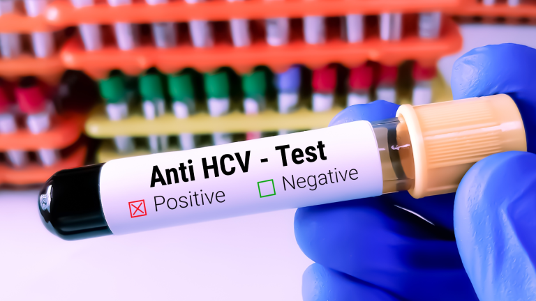 Anti HCV Testi