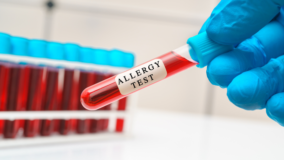 Kandan Alerji Testi Nedir?