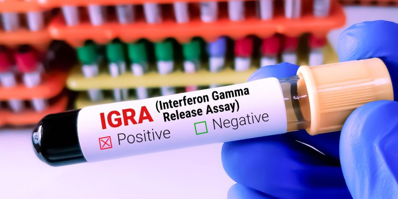 TB IGRA Testi Nedir?