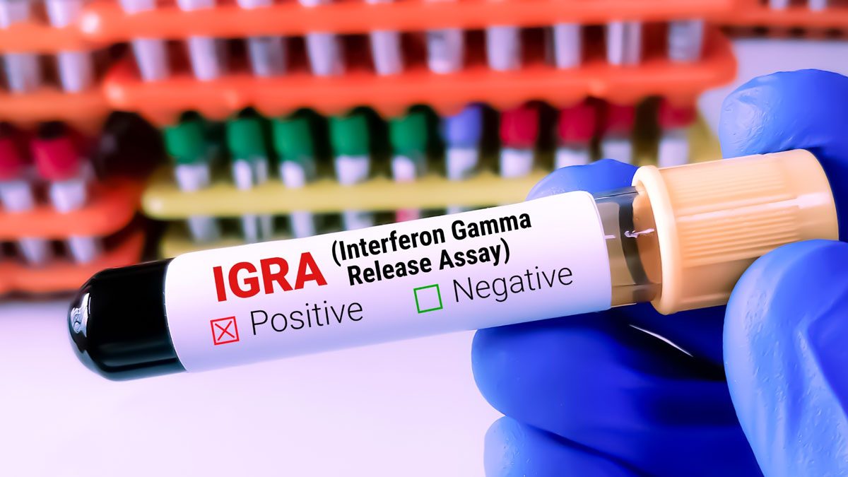 TB IGRA Testi Nedir? TB IGRA Testi Nedir?