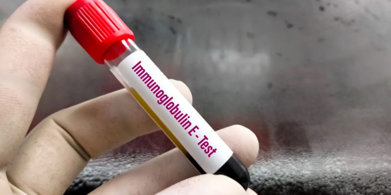 Total IgE Testi Nedir?