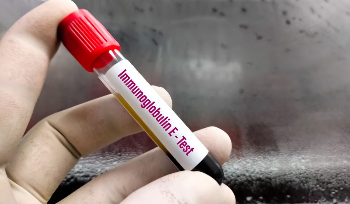 Total IgE Testi Nedir?