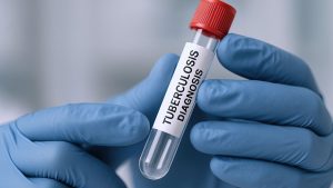 Verem (Tüberküloz) Testi Nedir?