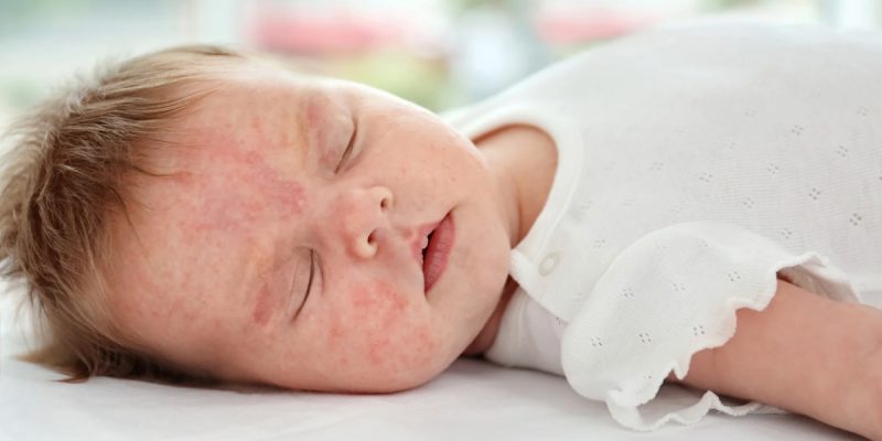 Bebeklerde Alerji Belirtileri Nelerdir?