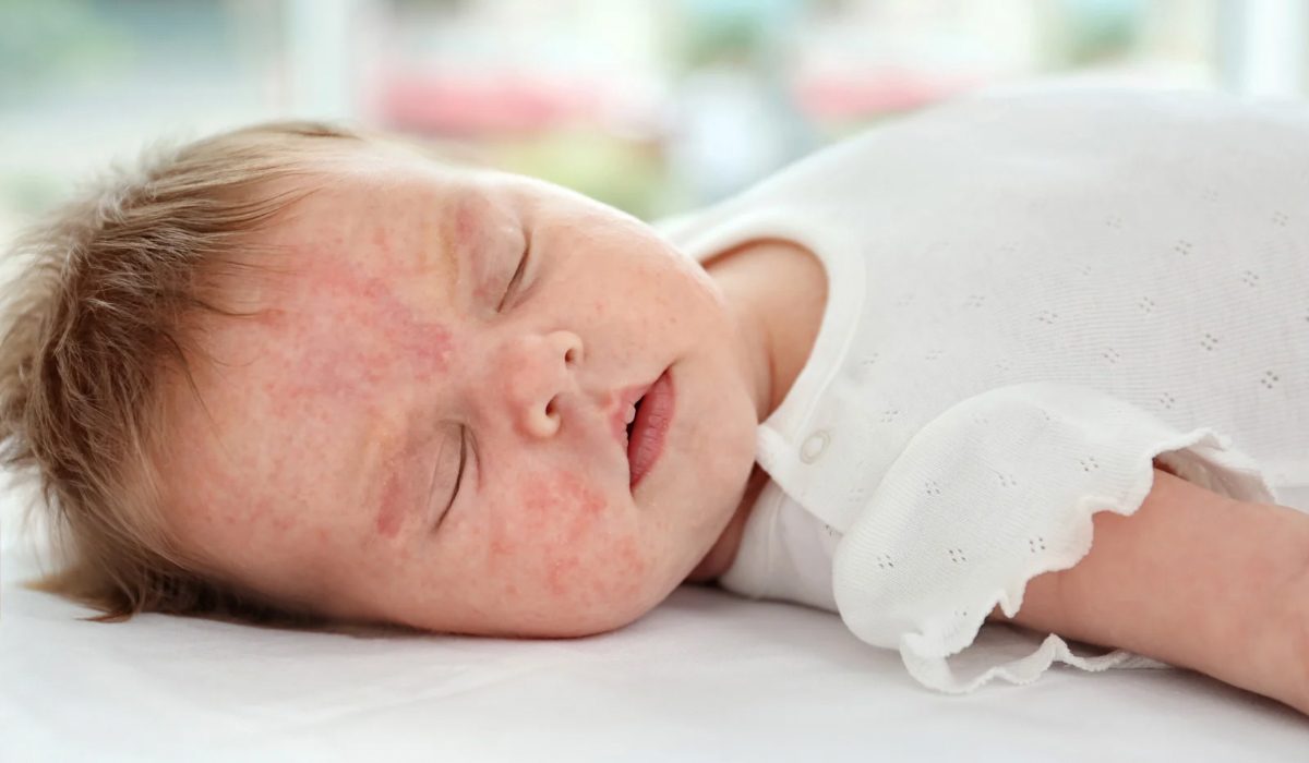 Bebeklerde Alerji Belirtileri Nelerdir?