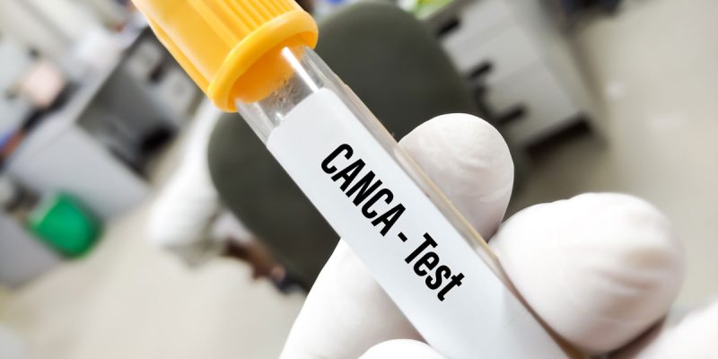 C-ANCA (PR3-ANCA) Testi Nedir?