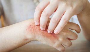 Ciltte Alerji Belirtileri Nelerdir?