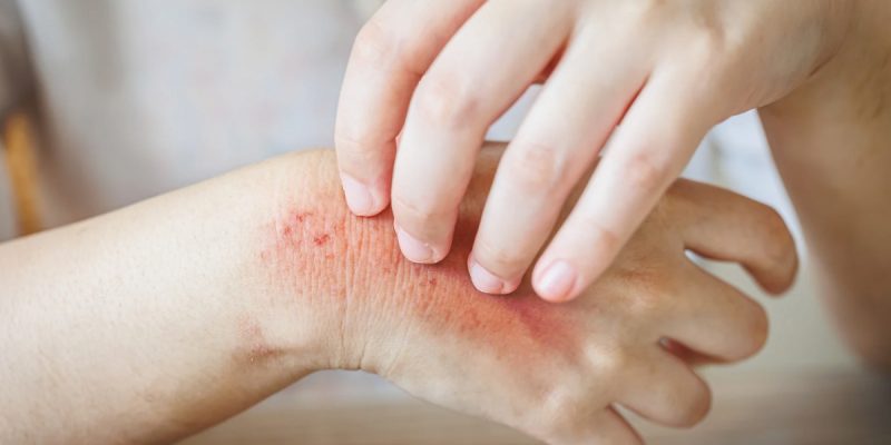 Ciltte Alerji Belirtileri Nelerdir?