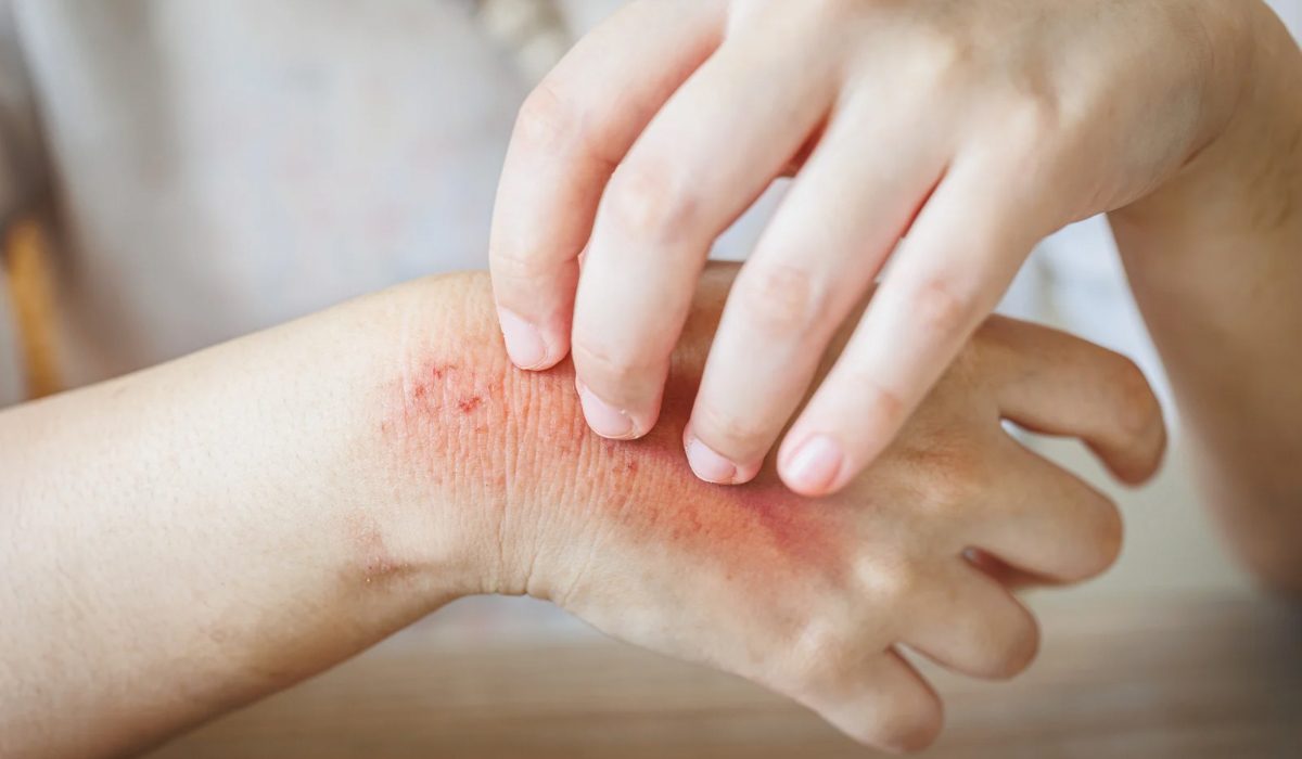 Ciltte Alerji Belirtileri Nelerdir?