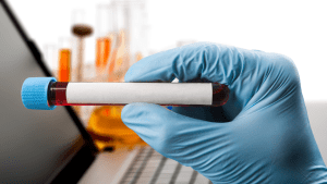 Eozinofil Katyonik Protein (ECP) Testi