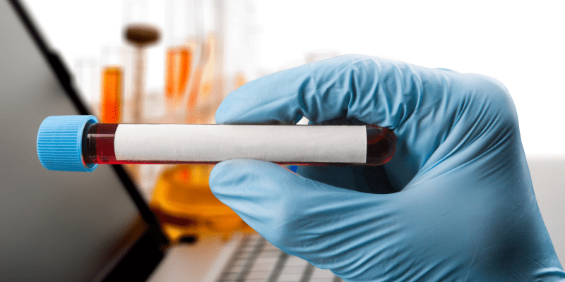 Eozinofil Katyonik Protein (ECP) Testi Nedir?