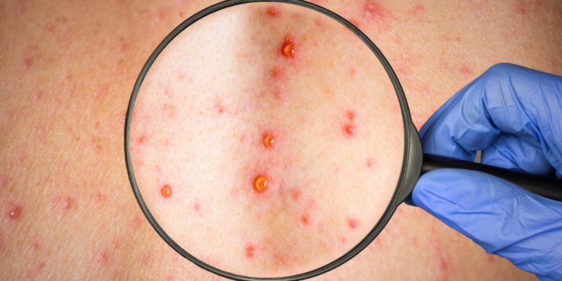 Erkeklerde HIV Belirtileri