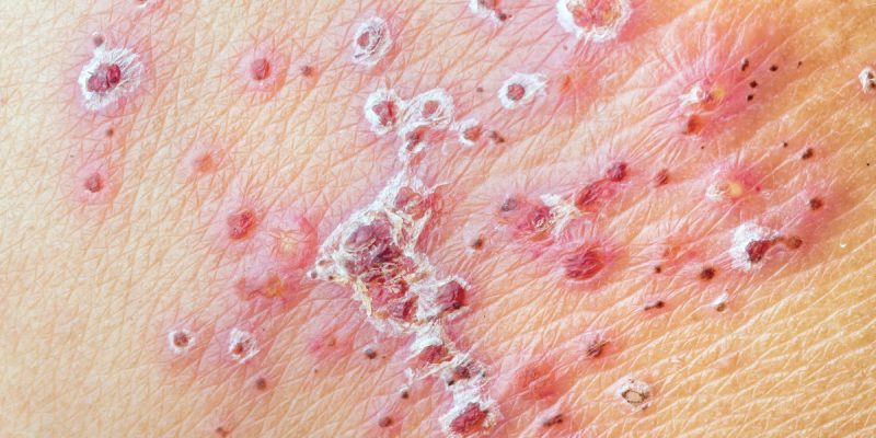 Genital Herpes Nedir?