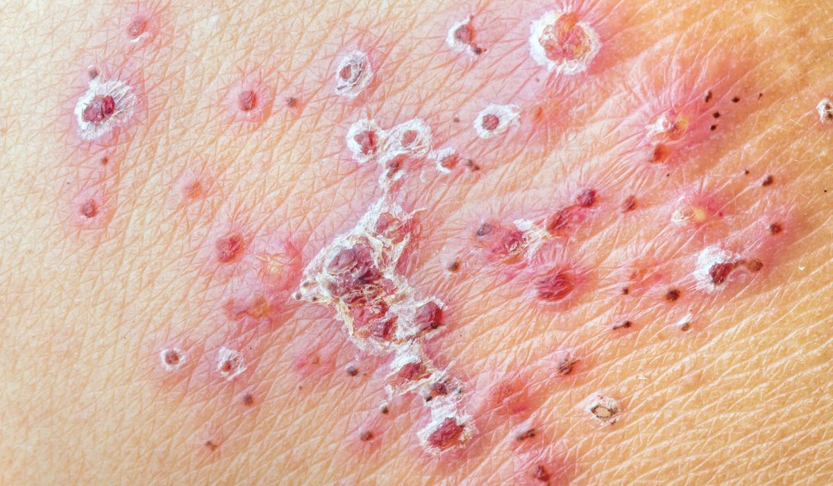 Genital Herpes Nedir?