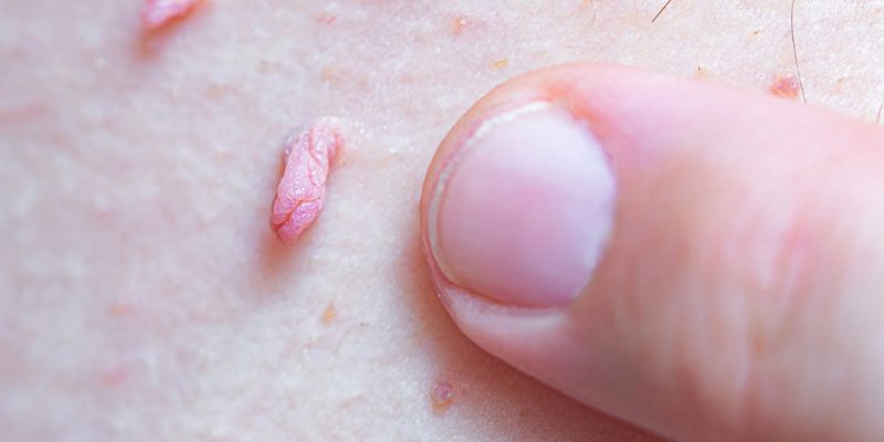 Genital Siğil Nedir?