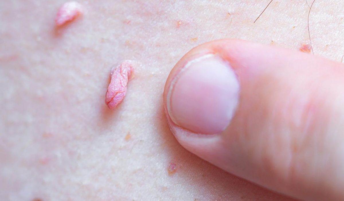 Genital Siğil Nedir?