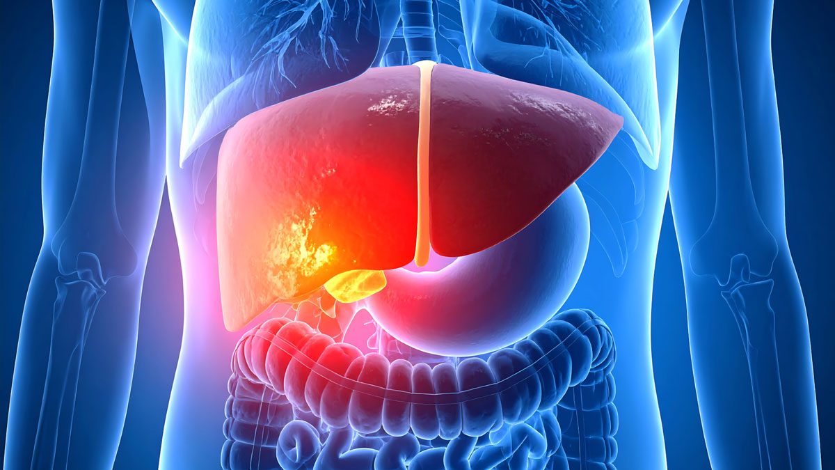 Hepatit A Belirtileri Nelerdir?