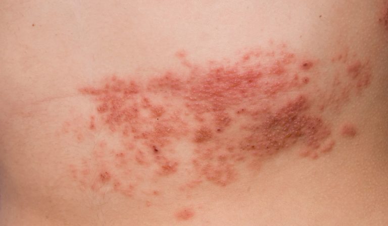 Herpes Belirtileri Nelerdir?