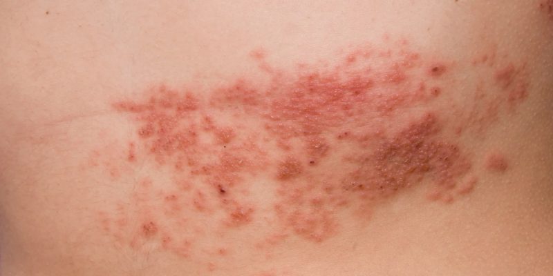Herpes Belirtileri Nelerdir?