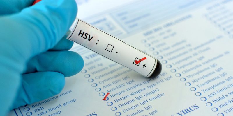 Herpes Testi Nedir?