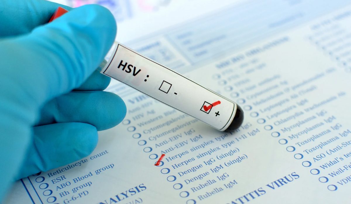 Herpes Testi Nedir?