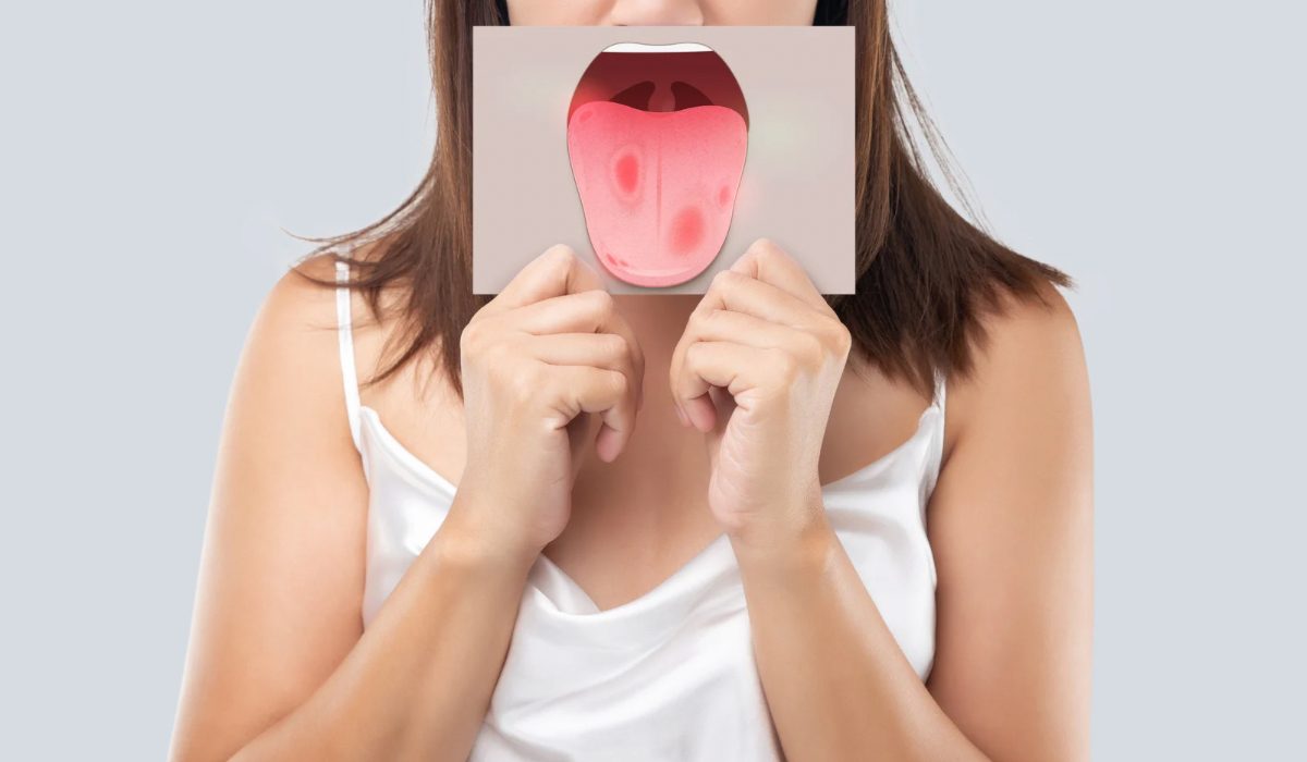 HIV Ağız Belirtileri Nelerdir?