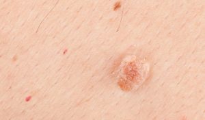 HPV Nasıl Anlaşılır?