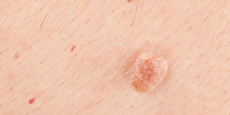 HPV Nasıl Anlaşılır?