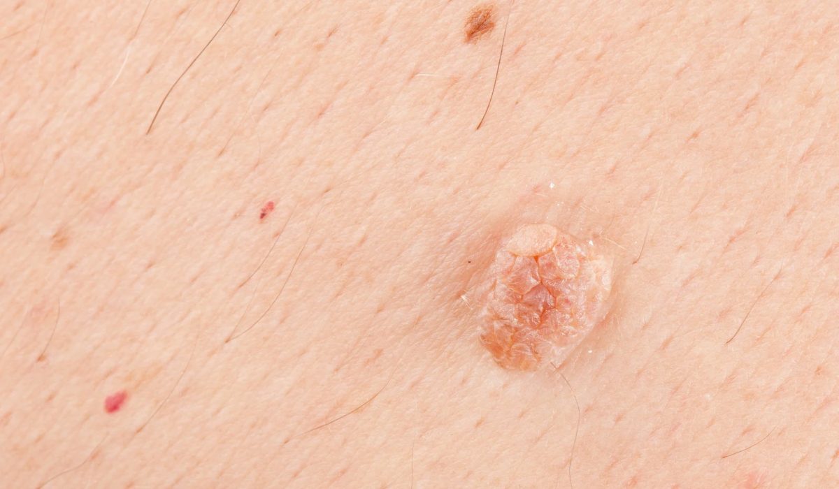 HPV Nasıl Anlaşılır?