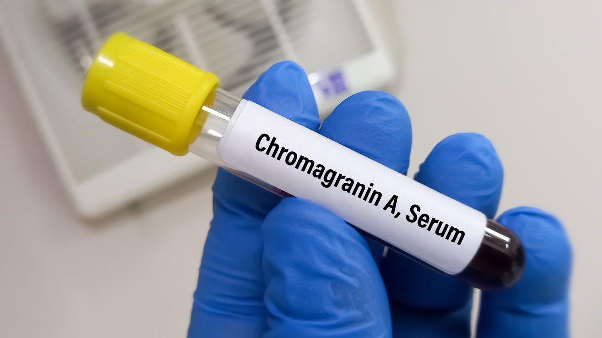Kromogranin A Testi