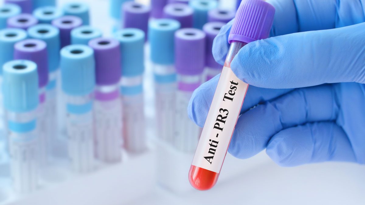 P-ANCA (MPO-ANCA) Testi Nedir?