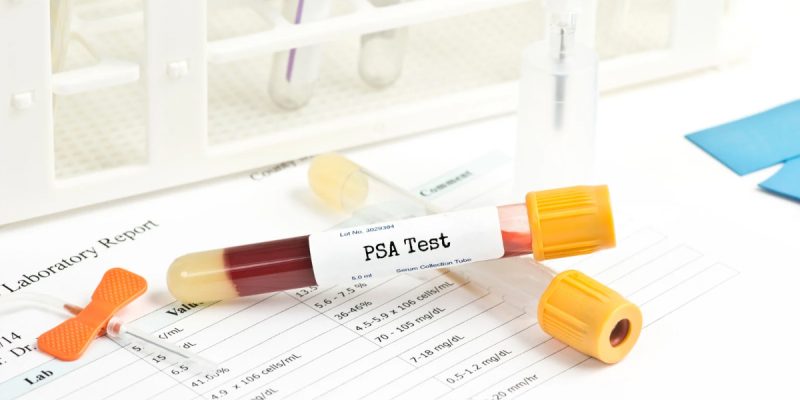 PSA Testi Nedir?